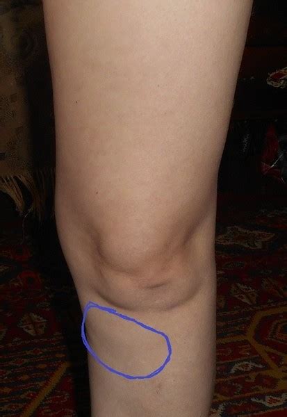 Причины и лечение боли суставов чуть ниже колена